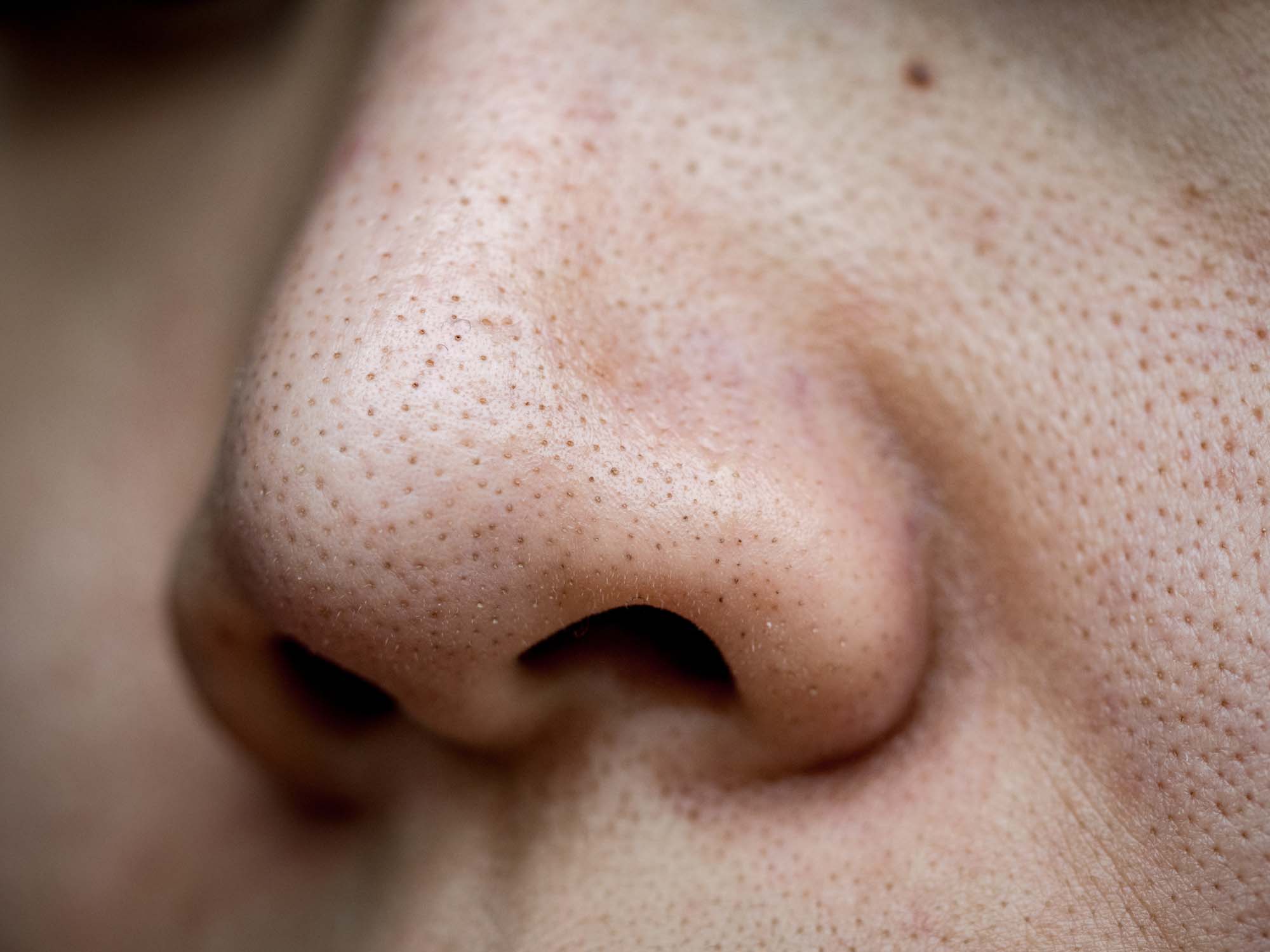 Big Blackheads: The Most Effective Treatments According To Experts - hvdwhy6